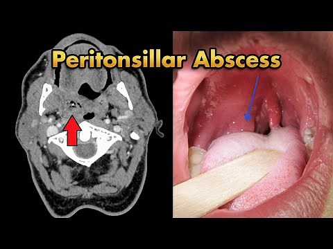 Peritonsillar Abscess (Quinsy): Pathophysiology, Clinical Features, Diagnosis and Treatment