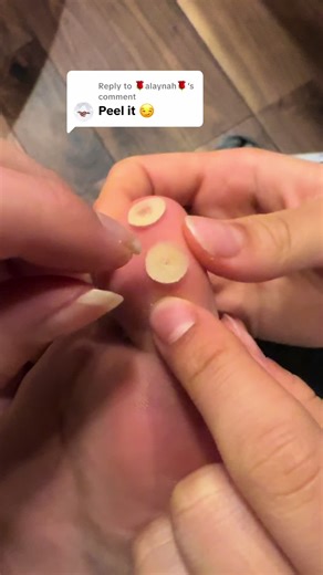 Understanding Foot Corns: Causes and Treatments