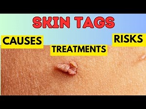 Skin Tags: What You Need to Know – Causes, Risks, and Removal Explained!