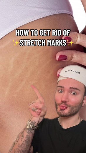 Effective Ways to Remove Stretch Marks Naturally!