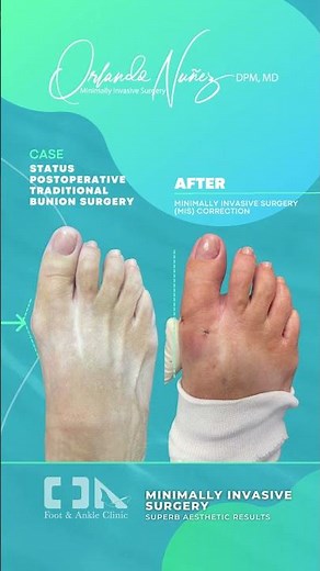 Bunion Surgery - Minimally Invasive Surgery