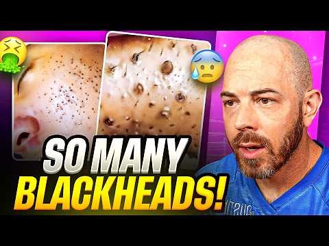 Extreme Blackhead Extractions You Have to See