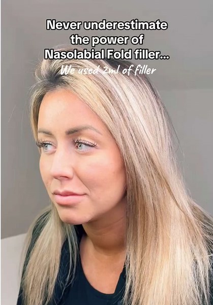 Revitalize with Nasolabial Fold Filler for a Youthful Look