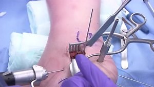 Surgical Fixation of Intra-Articular Calcaneus Fractures Using a Sinus Tarsi Approach
