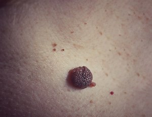 Nevus Comedonicus Syndrome (NCS)