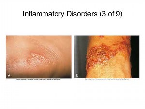 Integumentary System Disorders Explained: Psoriasis, Burns, Skin Cancer, and Infections