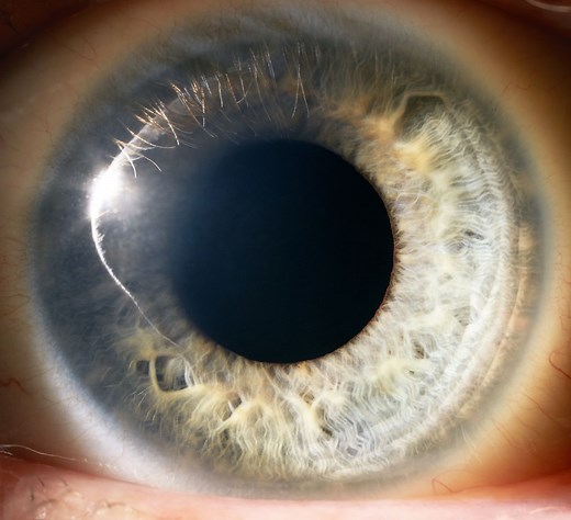 What Is a PERRLA Exam for the Eyes?