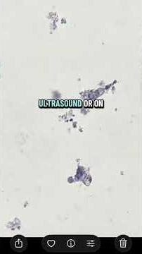 Explaining complete pathologic response #breastcancertreatment #breastcancer #chemotherapy