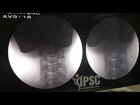 Cervical mediaL branch Radiofrequency ablation technique.