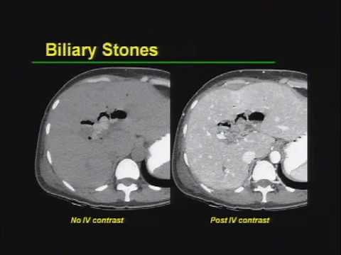 Biliary Tract Imaging [Basic Radiology]