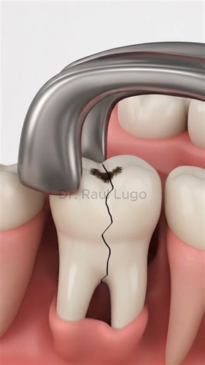 Animated Dental Extraction Procedure 3d Animation #3d #dentist #3danimation