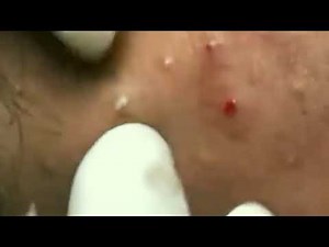 Severe Acne treatment