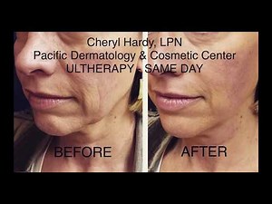 Ultherapy Demo to tighten face and neck. Nonsurgical procedure in Seattle.
