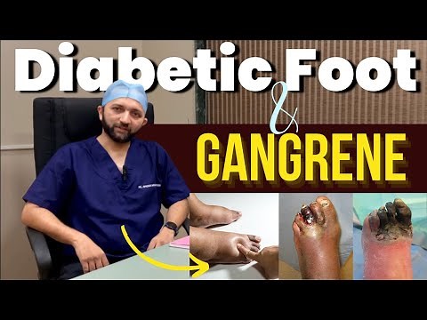 Diabetic Foot & Gangrene: Causes, Complications, and Management | Dr Amogh