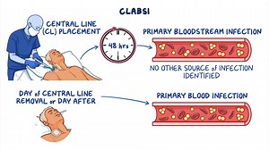 Video: Central line-associated bloodstream infection: Clinical sciences - Video Explanation! | Osmosis | Osmosis
