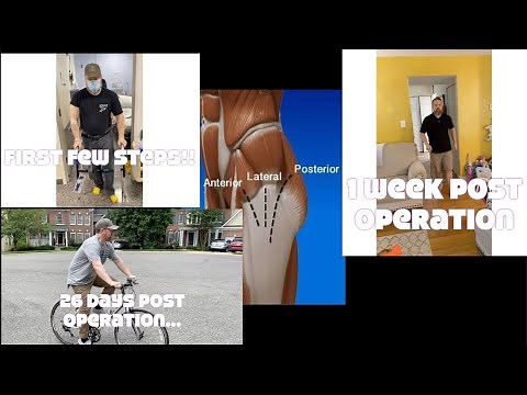 Total Hip Replacement Anterior Approach 0 to 4 week Recovery