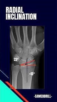 Distal radius fracture radiographic evaluation: Radial inclination