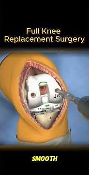 How Is a Full Knee Replacement Surgery Performed? Step-by-Step Procedure Explained #surgery #medical