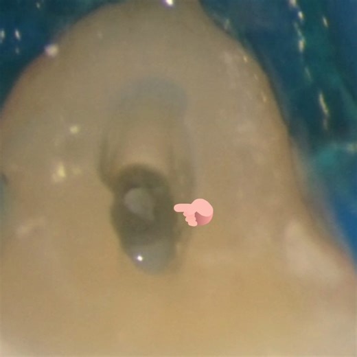 Management of severly calcified root canal of 42,#calcification #rootcanal #rct #endo