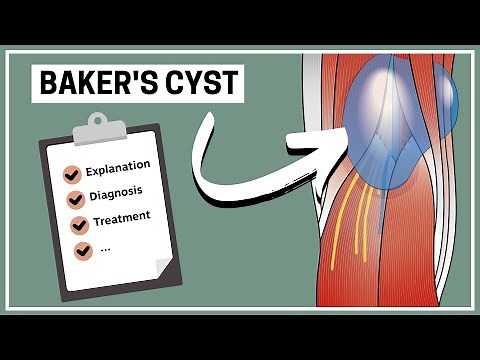What is a Baker's cyst (Explanation, Diagnosis and Treatment)