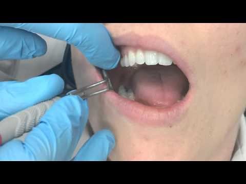 Mirror Retraction Techniques