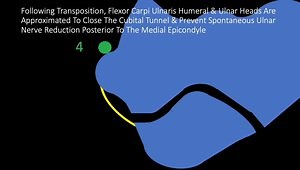 Cubital Tunnel Closure After Subcutaneous Transposition