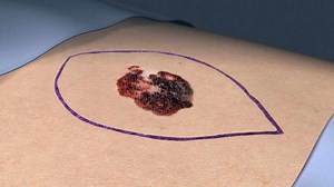 Removing skin cancer with Mohs surgery - Mayo Clinic News Network