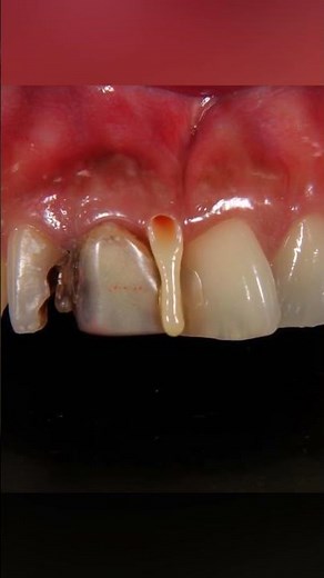 What Is a Dental Abscess? (Purulent Periodontitis Explained) #dentist #dentalartistry #sherts