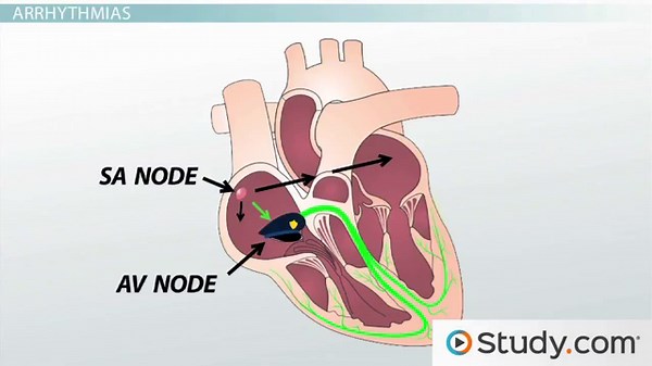 Arrhythmia Definition, Types & ECG Detection
