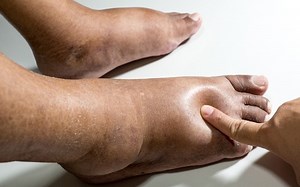 Why Are My Feet Swollen - Causes, Treatments, and Prevention