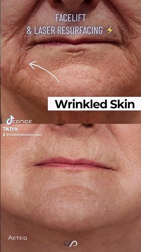 Unveiling the Magic of Facelift and Laser Resurfacing - Watch our Before and After Video!