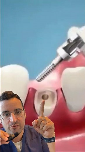 Astuce : l’EXTRACTION dentaire MÉCANIQUE