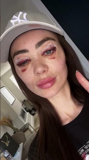 Upper & Lower Blepharoplasty (Eyelid Surgery) with Signature Clinic #blepharoplasty #eyelidsurgery