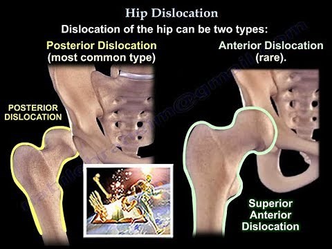 Dislocation of the hip - Everything You Need To Know - Dr. Nabil Ebraheim