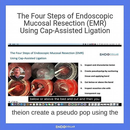 The Four Steps of Endoscopic Mucosal Resection (EMR) Using Cap-Assisted Ligation