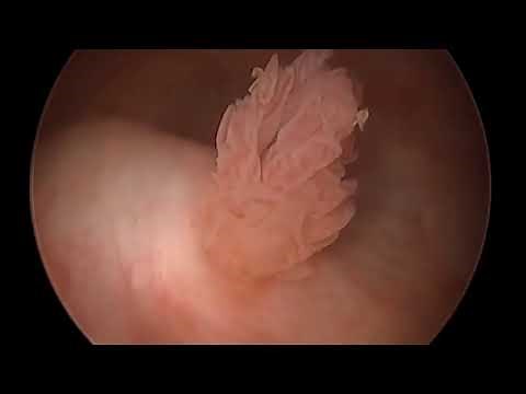 Urothelial Carcinoma