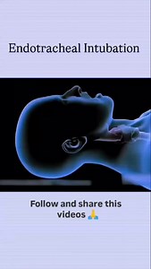 3.8K views · 4.3K reactions | Endotracheal intubation is a medical...