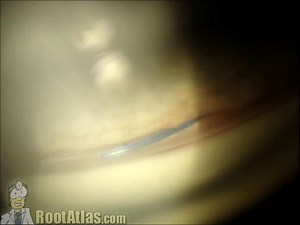Gonioscopy with lens haptic (Video) - TimRoot.com