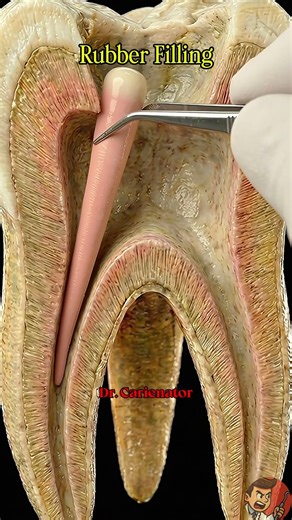 Root Canal Treatment: Step by Step 🦷✨