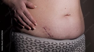 Woman showing the stomach with a appendicitis scar after surgery. Scar removal