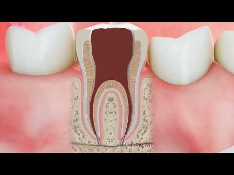 Root Canal Treatment Explained: Step-by-Step Animated Procedure