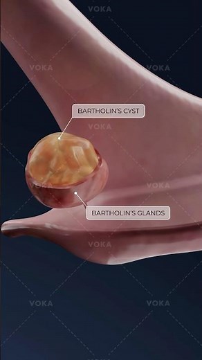 What is a Bartholin cyst and how does it affect women’s health? Gynecology in 3D with VOKA!