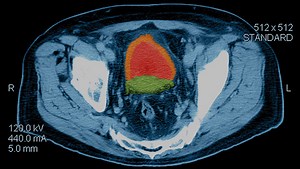 New Breakthroughs in Prostate Cancer Treatment | Clinical Trials | Genitourinary Cancer | Patient Care | UT Southwestern Medical Center