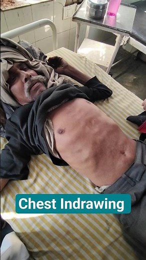 Chest Indrawing #clinicalvideos