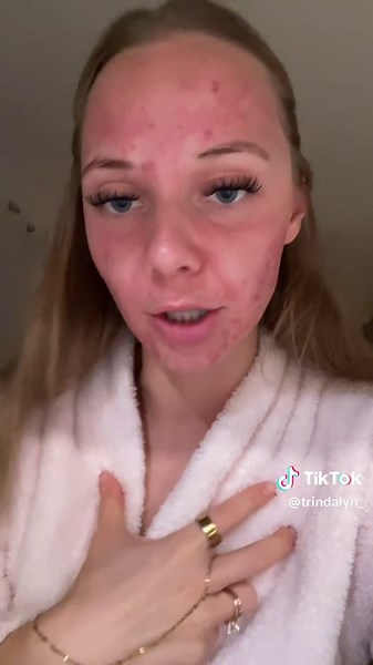 Bro what is happening #acne