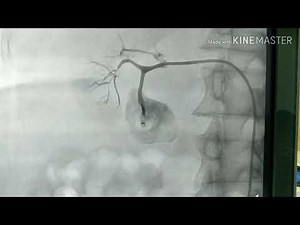 Renal artery coiling/embolization