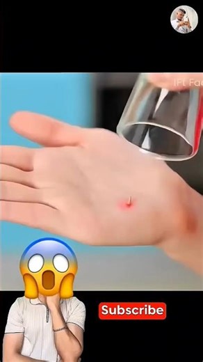 How to Remove a Splinter from Your Hand Easily | Simple & Safe Method