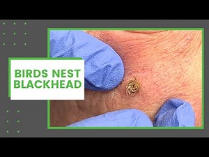 Birds Nest Blackhead | Dr. Derm