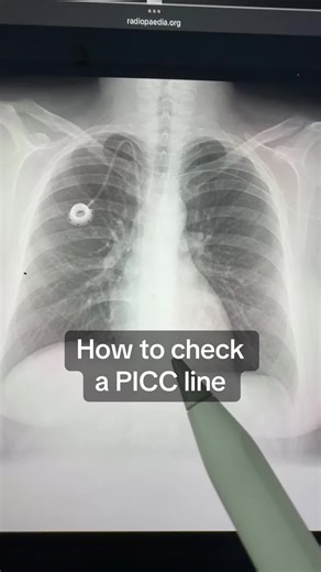 How to Check Your PICC Line Position