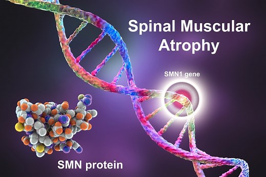 What are the Different Types of Spinal Muscular Atrophy?